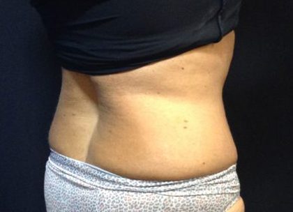 CoolSculpting Before & After Patient #171