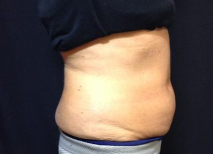 CoolSculpting Before & After Patient #171