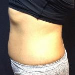 CoolSculpting Before & After Patient #171