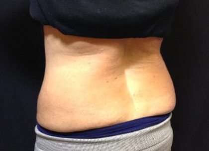 CoolSculpting Before & After Patient #171