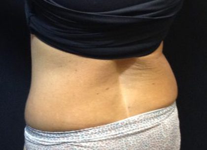 CoolSculpting Before & After Patient #171