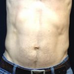 CoolSculpting Before & After Patient #158