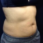 CoolSculpting Before & After Patient #157