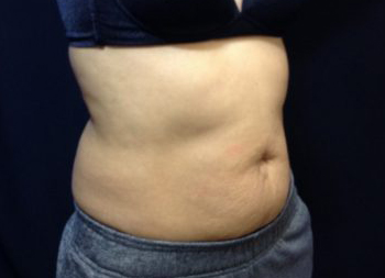 CoolSculpting Before & After Patient #157