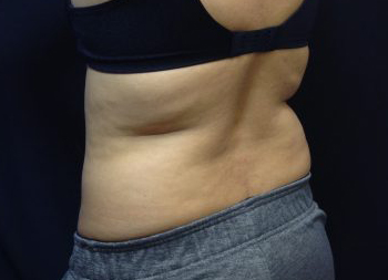 CoolSculpting Before & After Patient #157