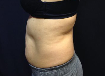 CoolSculpting Before & After Patient #157