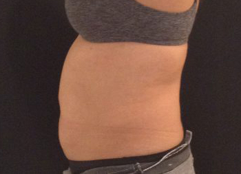 CoolSculpting Before & After Patient #157