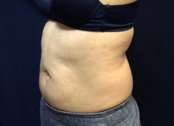 CoolSculpting Before & After Patient #157