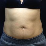 CoolSculpting Before & After Patient #157