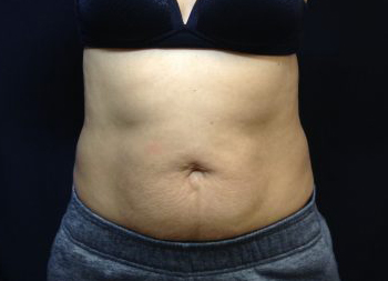 CoolSculpting Before & After Patient #157