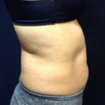 CoolSculpting Before & After Patient #157