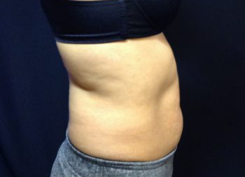 CoolSculpting Before & After Patient #157