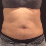 CoolSculpting Before & After Patient #157