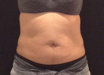 CoolSculpting Before & After Patient #157