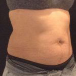 CoolSculpting Before & After Patient #157