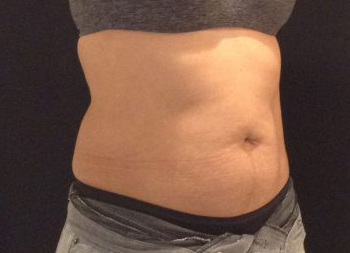 CoolSculpting Before & After Patient #157