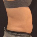 CoolSculpting Before & After Patient #157