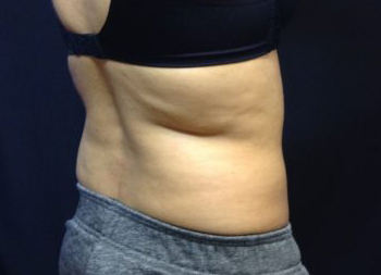 CoolSculpting Before & After Patient #157