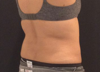 CoolSculpting Before & After Patient #157