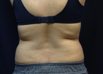 CoolSculpting Before & After Patient #157