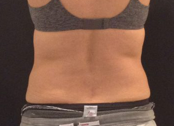 CoolSculpting Before & After Patient #157