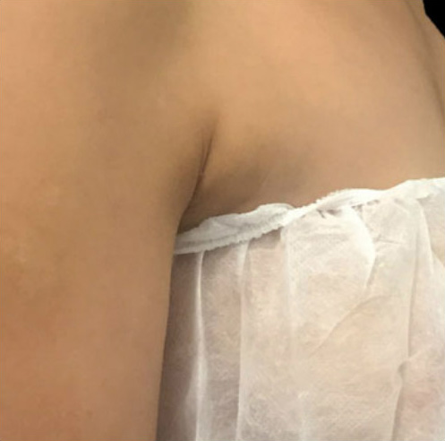 CoolMini Before & After Patient #999
