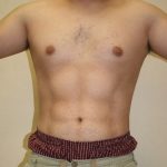 Vaser Lipo Before & After Patient #1037