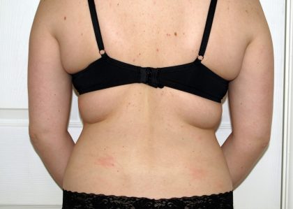 Vaser Lipo Before & After Patient #1042