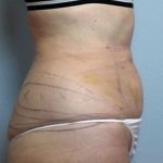 Vaser Lipo Before & After Patient #1048