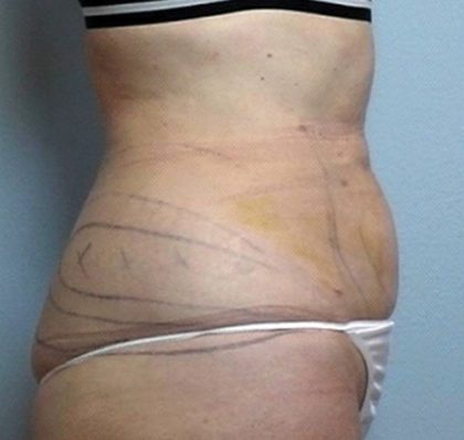 Vaser Lipo Before & After Patient #1048