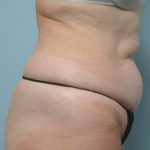 Vaser Lipo Before & After Patient #1048