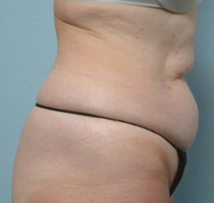 Vaser Lipo Before & After Patient #1048