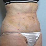 Vaser Lipo Before & After Patient #1048