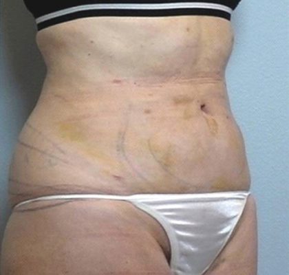 Vaser Lipo Before & After Patient #1048