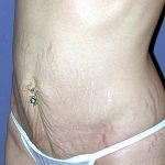 Vaser Lipo Before & After Patient #1053