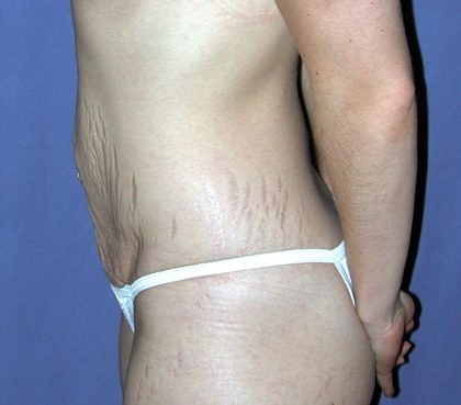 Vaser Lipo Before & After Patient #1053