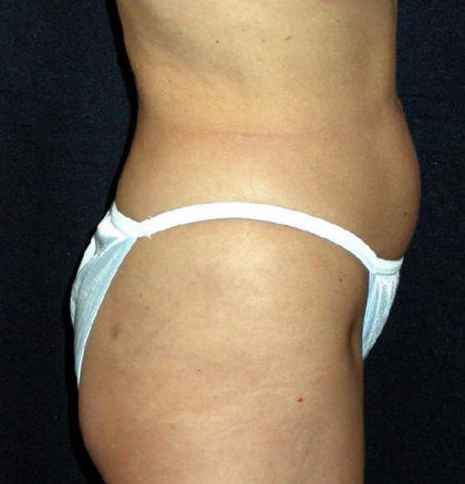 Vaser Lipo Before & After Patient #1058