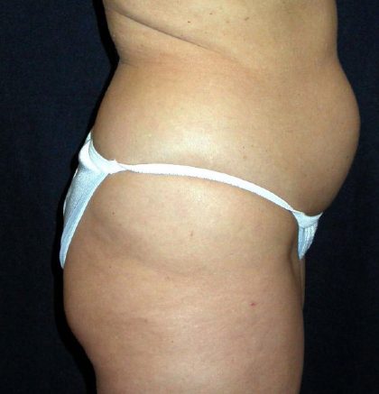 Vaser Lipo Before & After Patient #1058