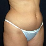 Vaser Lipo Before & After Patient #1058