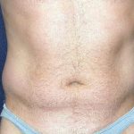 Vaser Lipo Before & After Patient #1063