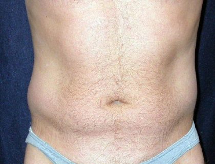 Vaser Lipo Before & After Patient #1063