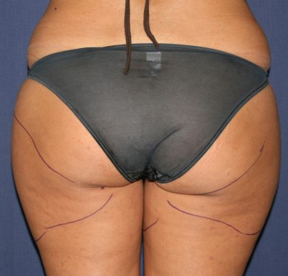 Vaser Lipo Before & After Patient #1068