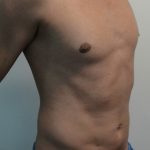 Vaser Lipo Before & After Patient #1071