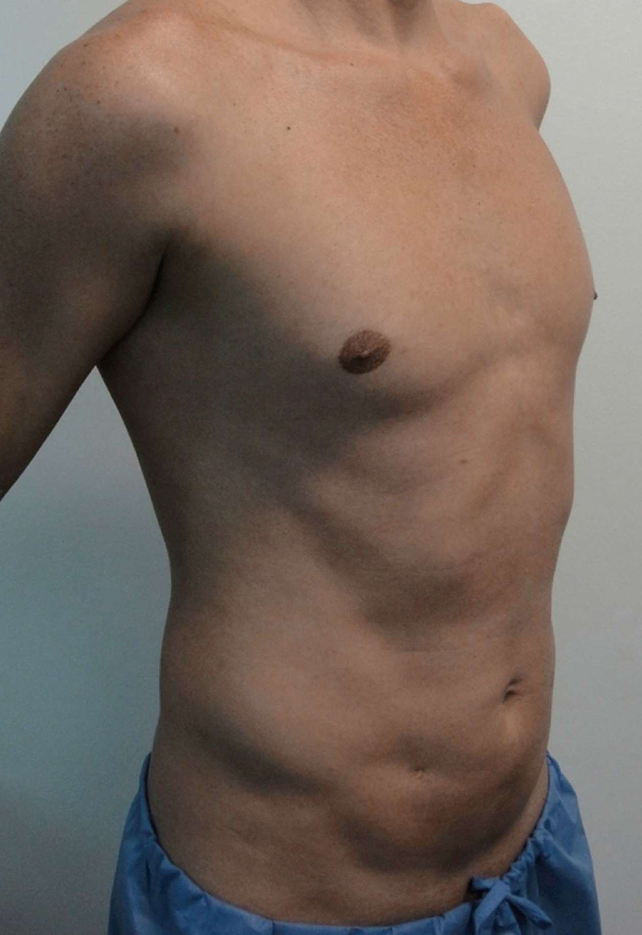 Vaser Lipo Before & After Patient #1071