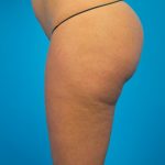 Vaser Lipo Before & After Patient #1074
