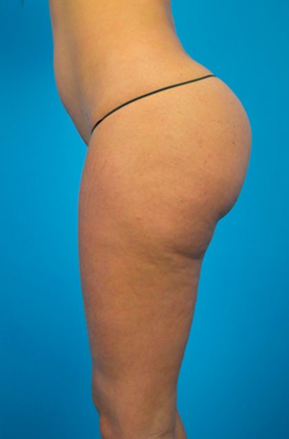 Flanks Lipo - High Definition Flank Liposuction