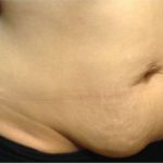 CoolSculpting Before & After Patient #868