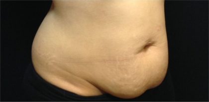 CoolSculpting Before & After Patient #868