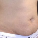 CoolSculpting Before & After Patient #868