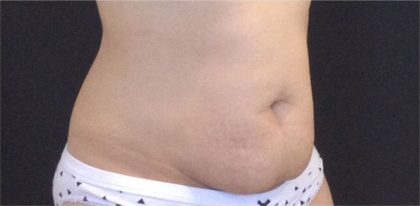 CoolSculpting Before & After Patient #868